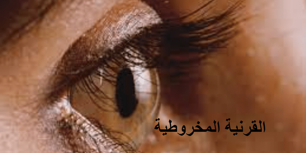 نصائح للوقاية من أمراض قرنية العين