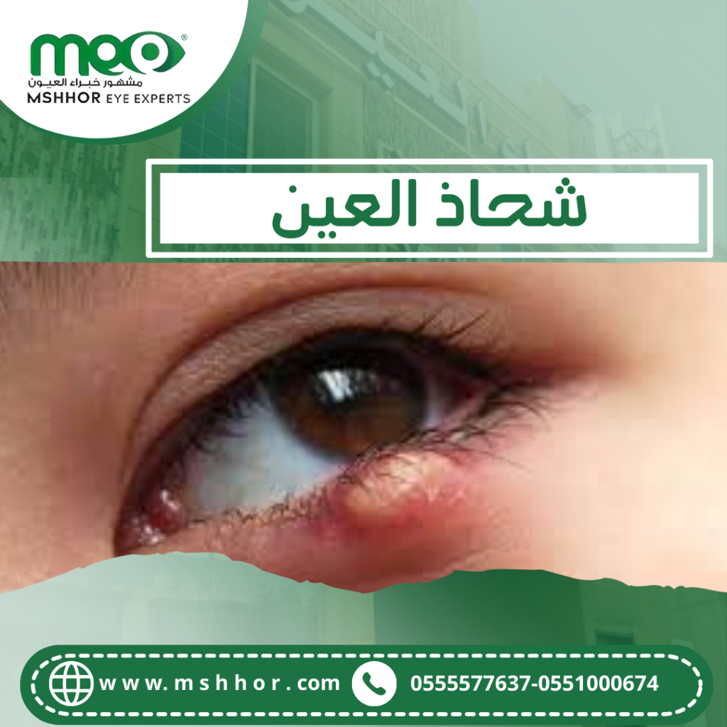 وصفات طبيعية لعلاج شحاذ العين