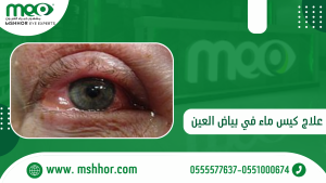 كيس مائي في جفن العين | أسباب الإصابة وطرق العلاج 