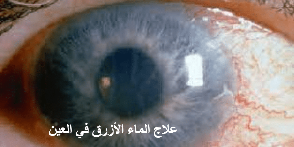 علاج الماء الأزرق في العين
