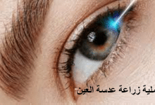 عملية زراعة عدسة العين