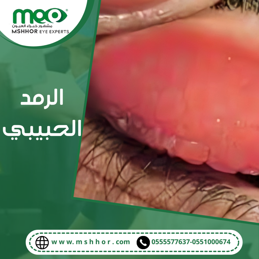 الرمد الحبيبي أسبابه وأهم أعراضه2024