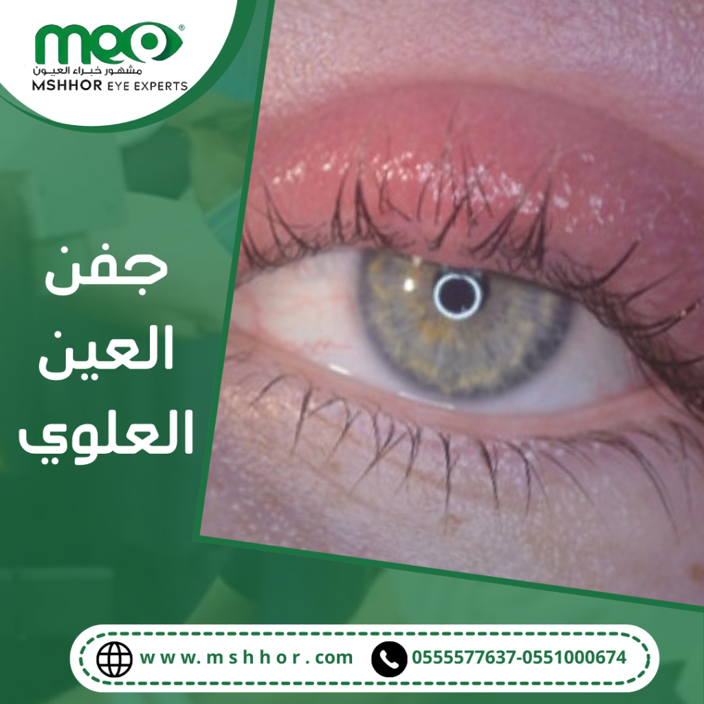 طرق الوقاية من التهاب جفن العين العلوي