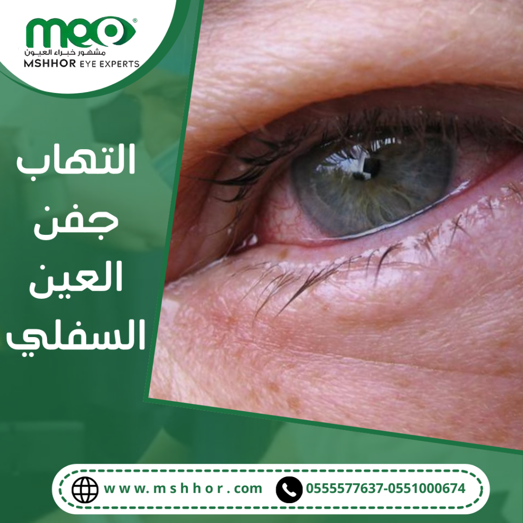 طرق علاج التهاب جفن العين السفلي