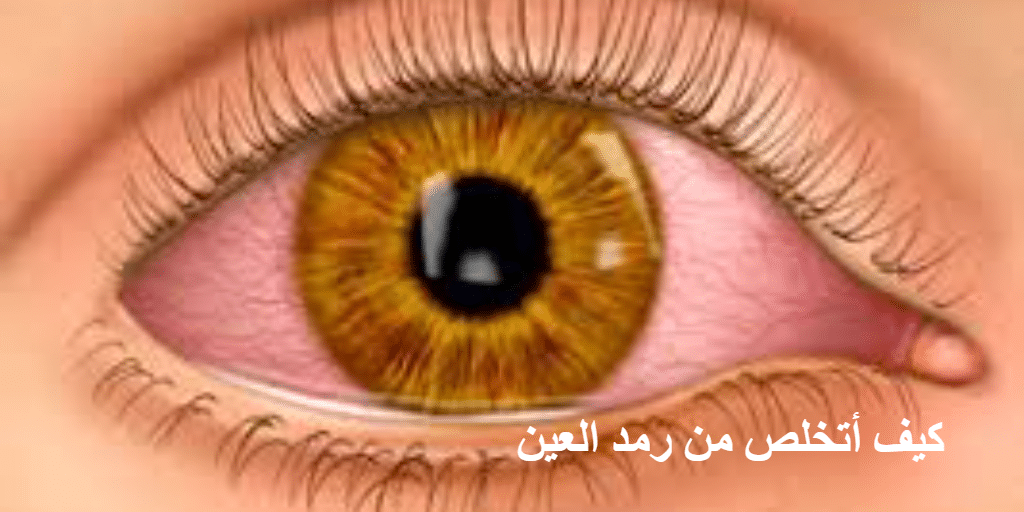كيف أتخلص من رمد العين