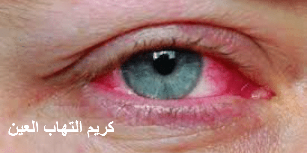 كريم التهاب العين