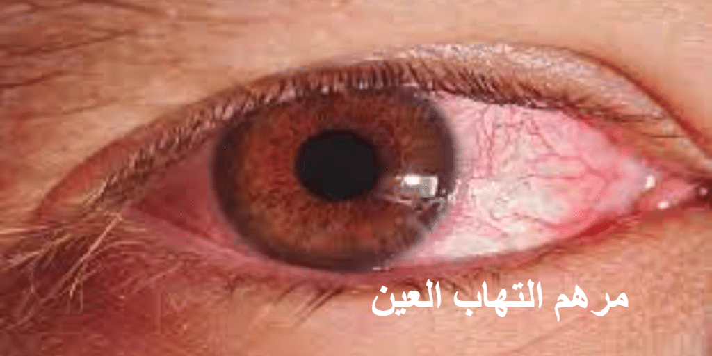 مرهم التهاب العين