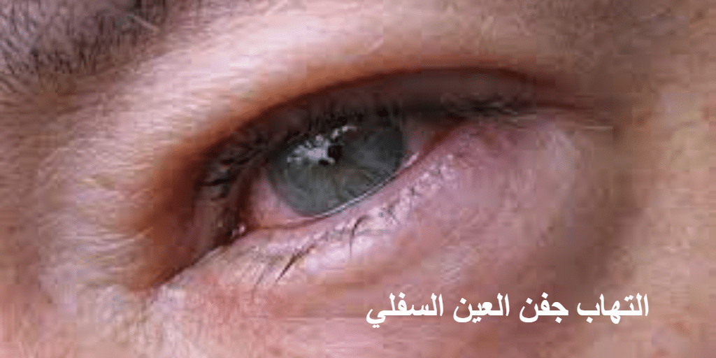 التهاب جفن العين السفلي