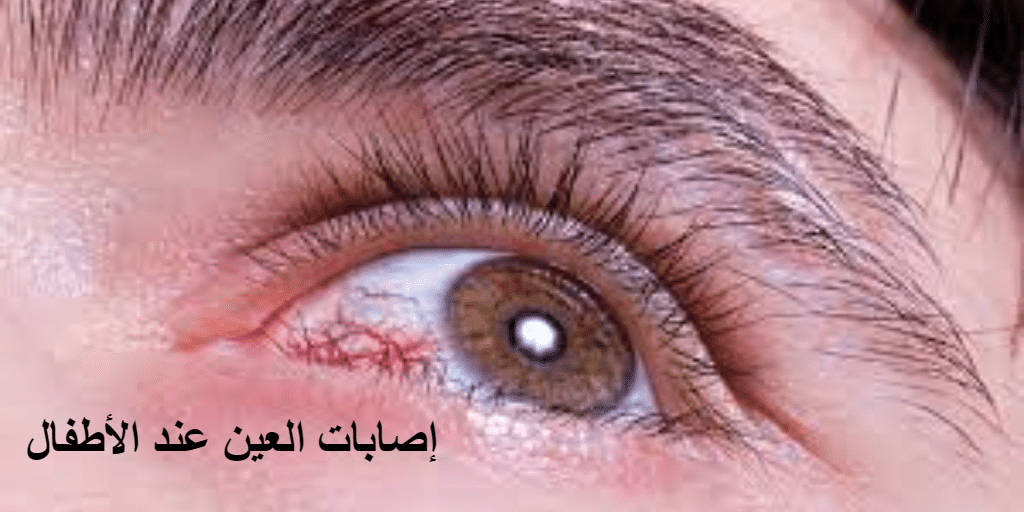 إصابات العين عند الأطفال