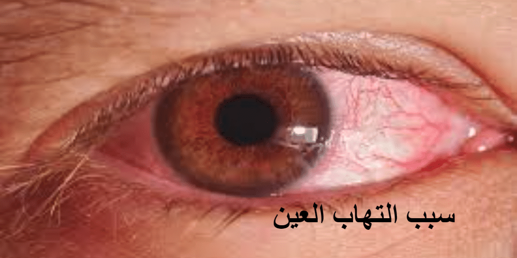 سبب التهاب العين