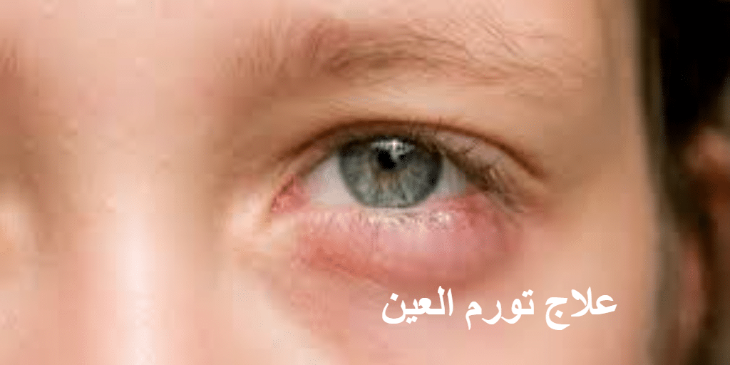 علاج تورم العين المفاجئ