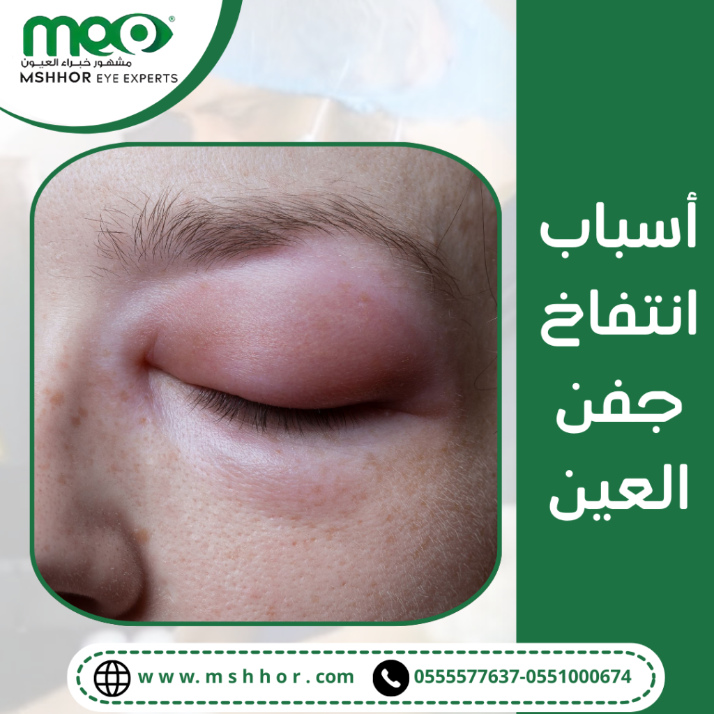 أعراض التهاب جفن العين