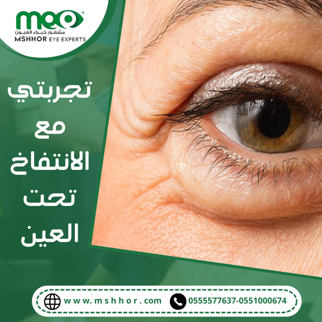 العلاجات المحتملة لعلاج انتفاخ العين