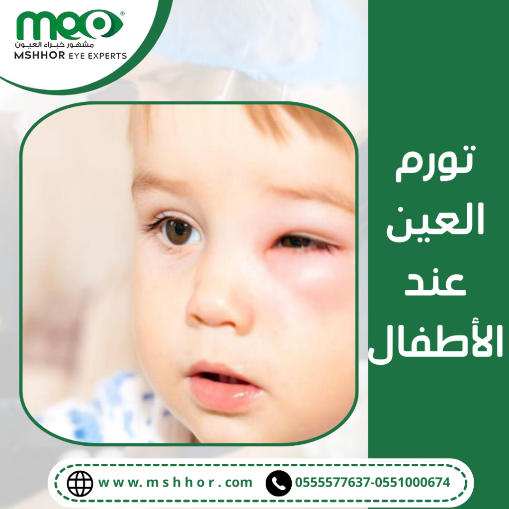 أسباب حدوث تورم العين عند الأطفال