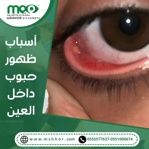 أسباب ظهور حبوب داخل جفن العين ومتى تستدعي الفحص الطبي
