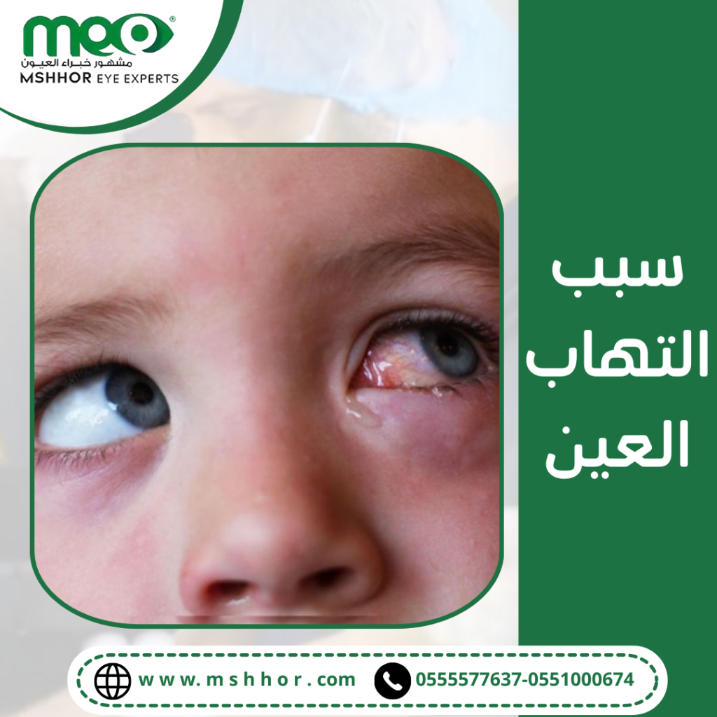 سبب التهاب العين عن الأطفال بسبب الحساسية