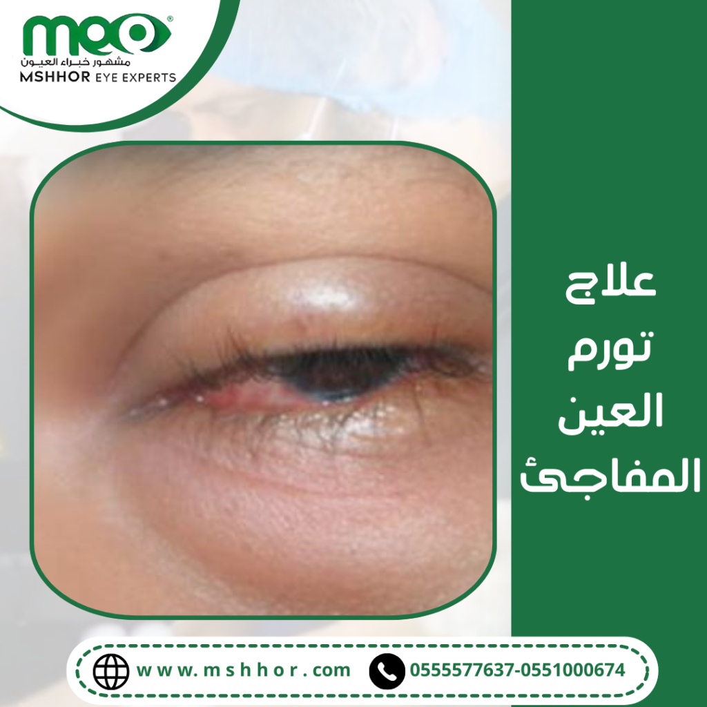 العلاج الجراحي لعلاج تورم العين المفاجئ