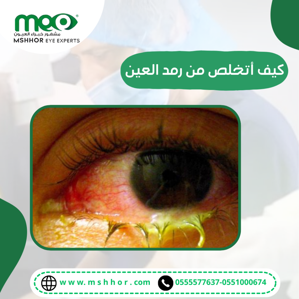 كيف أتخلص من رمد العين نهائيا 2024