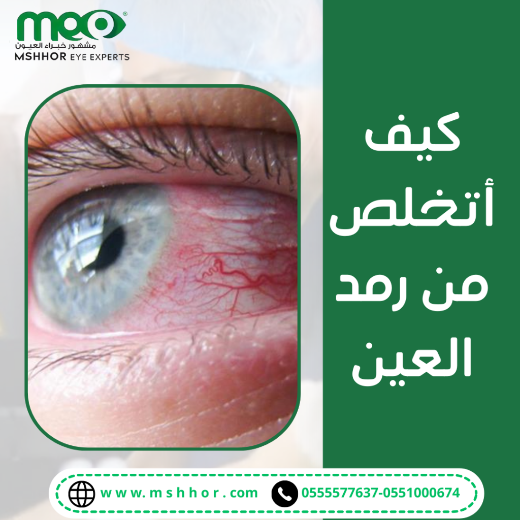 كيف أتخلص من رمد العين نهائيا 2024