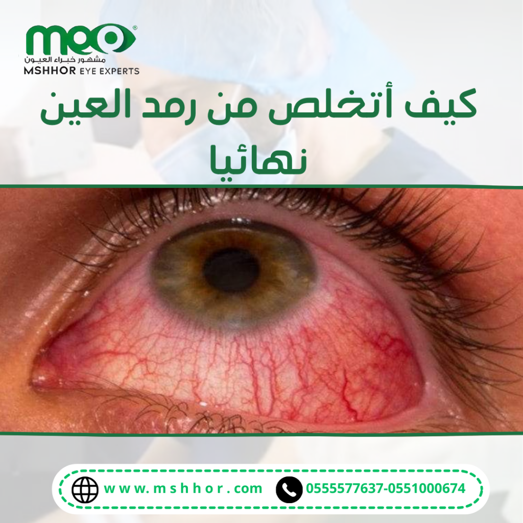 كيف أتخلص من رمد العين نهائيا 2024