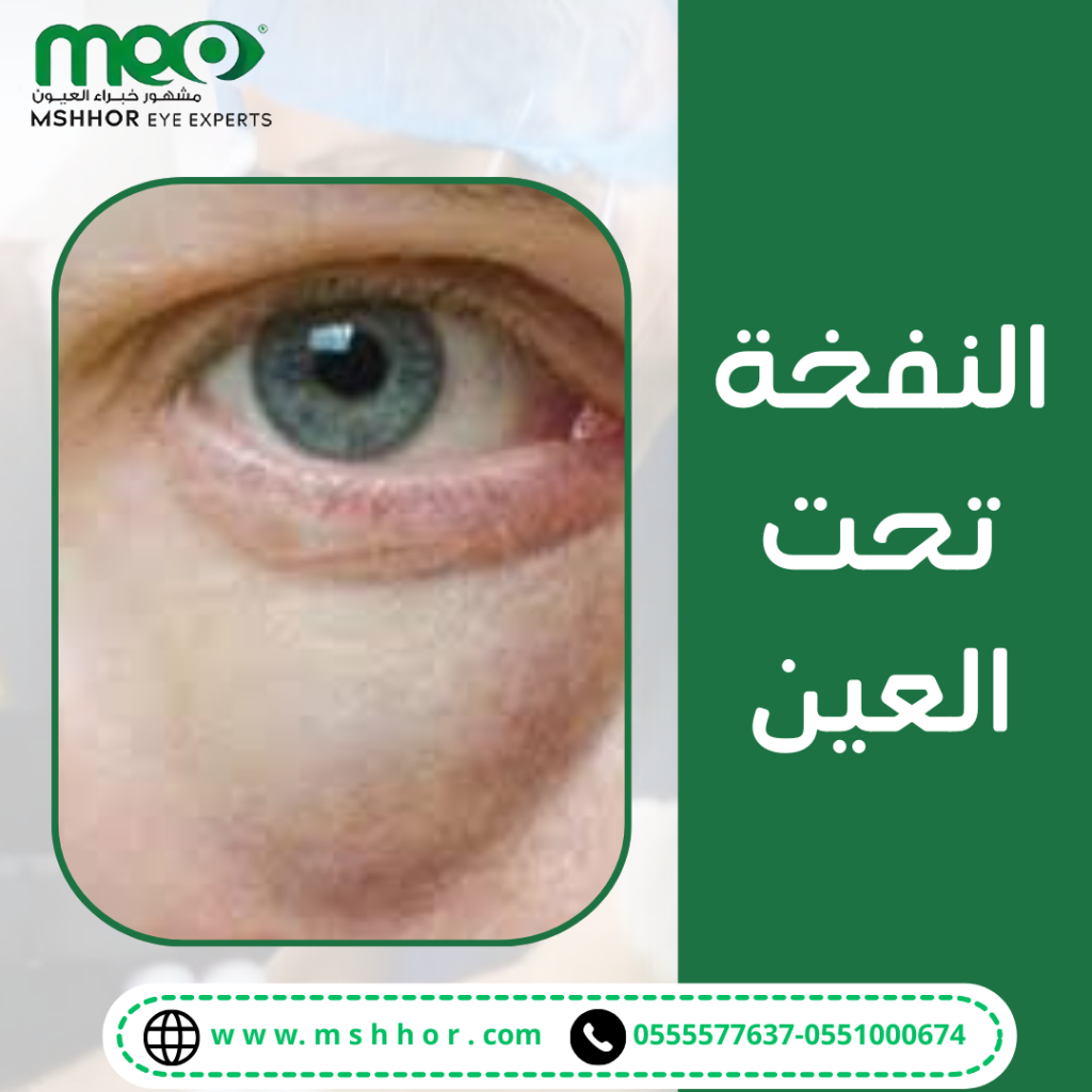 طرق علاج النفخة تحت العين
