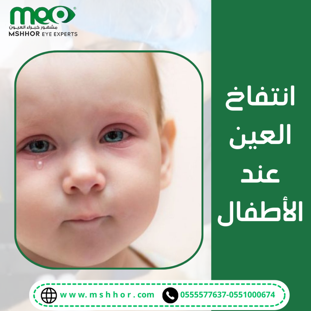 طرق علاج انتفاج العين عند الأطفال