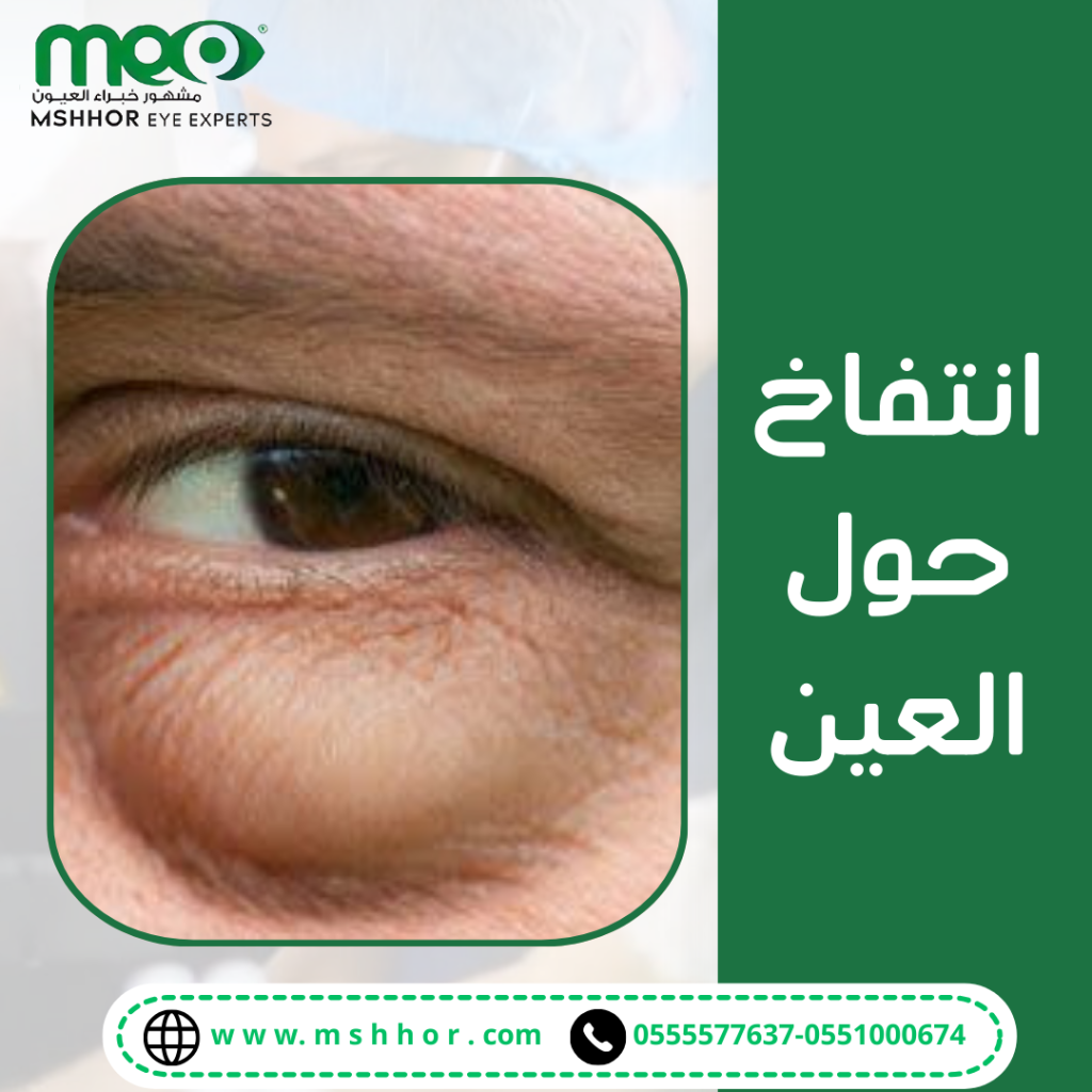 طرق علاج الانتفاخ حول العين