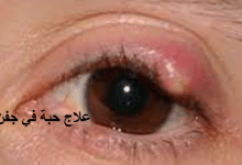 علاج حبة في جفن العين العلوي