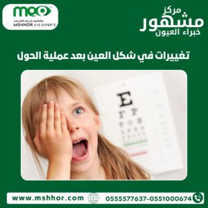 تغييرات في شكل العين بعد عملية الحول