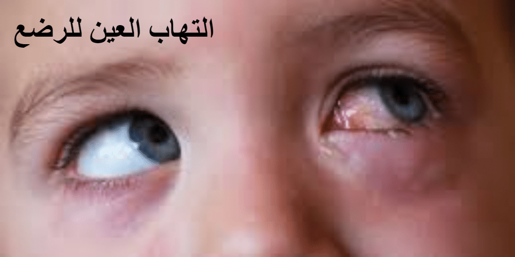 التهاب العين للرضع