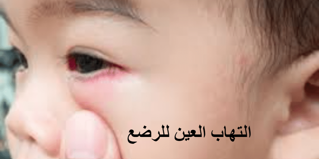 التهاب العين للرضع