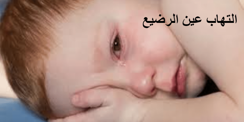 التهاب عين الرضيع