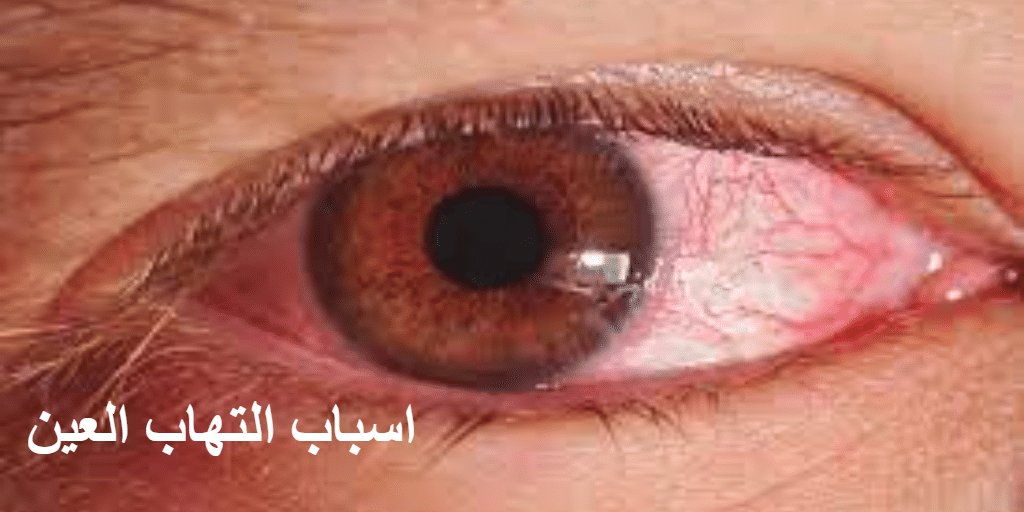 اسباب التهاب العين