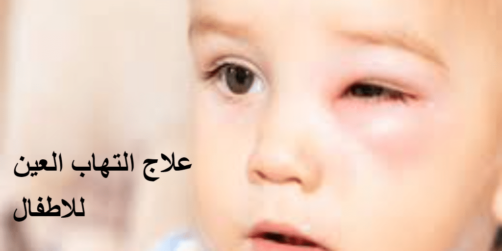علاج التهاب العين للاطفال