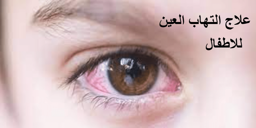 علاج التهاب العين للاطفال