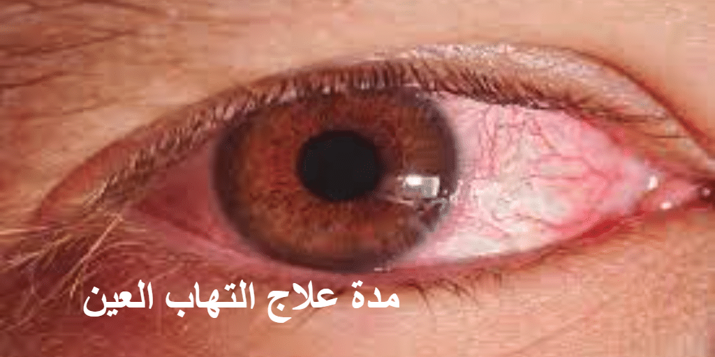 مدة علاج التهاب العين