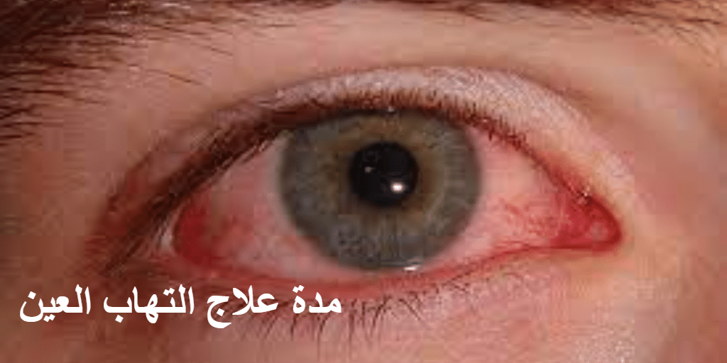 مدة علاج التهاب العين