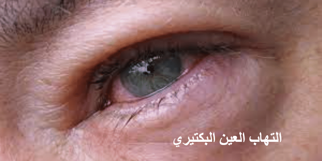 التهاب العين البكتيري