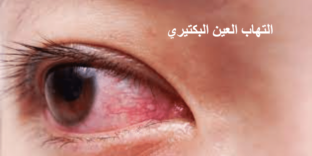 التهاب العين البكتيري