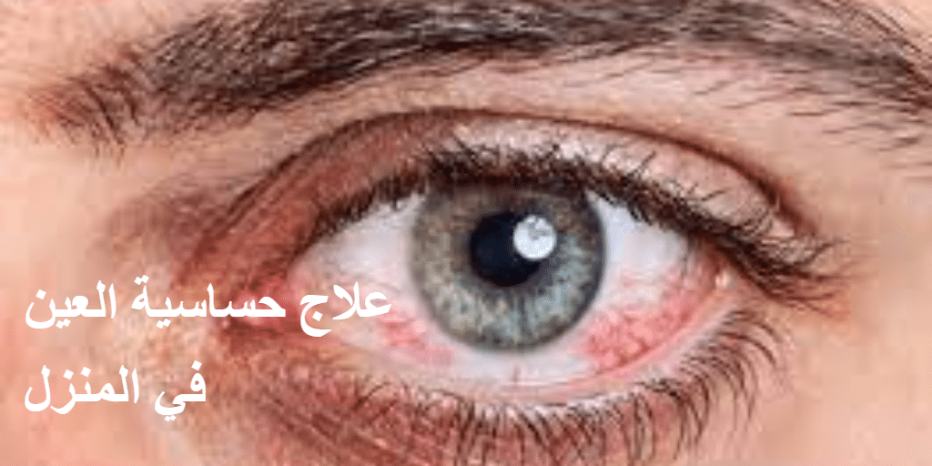 علاج حساسية العين في المنزل