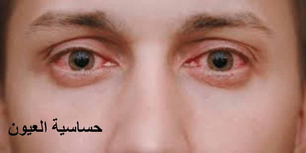 حساسية العيون