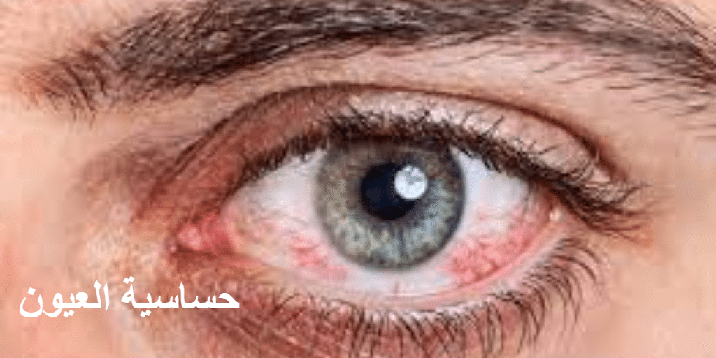 حساسية العيون