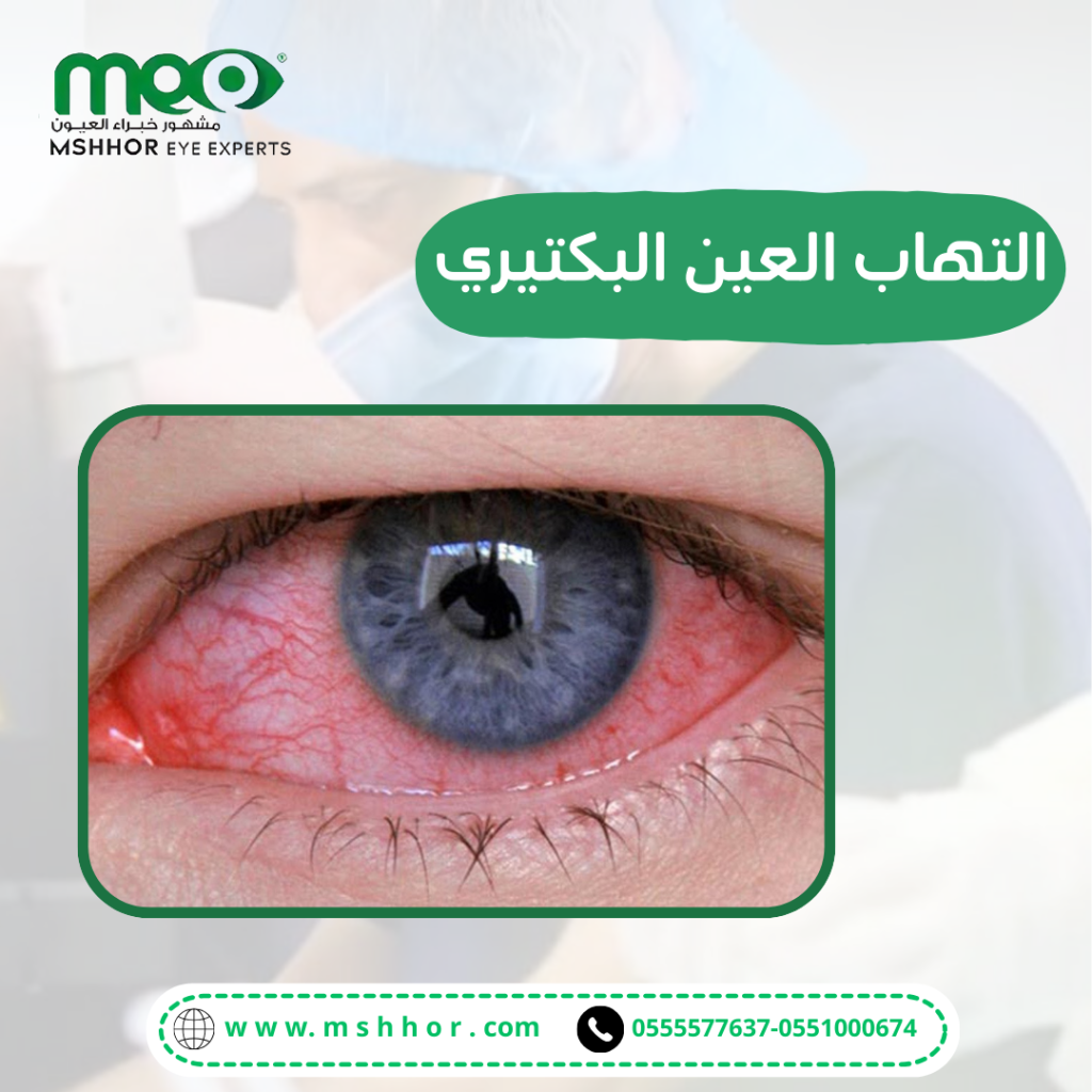 ما هو التهاب العين البكتيري