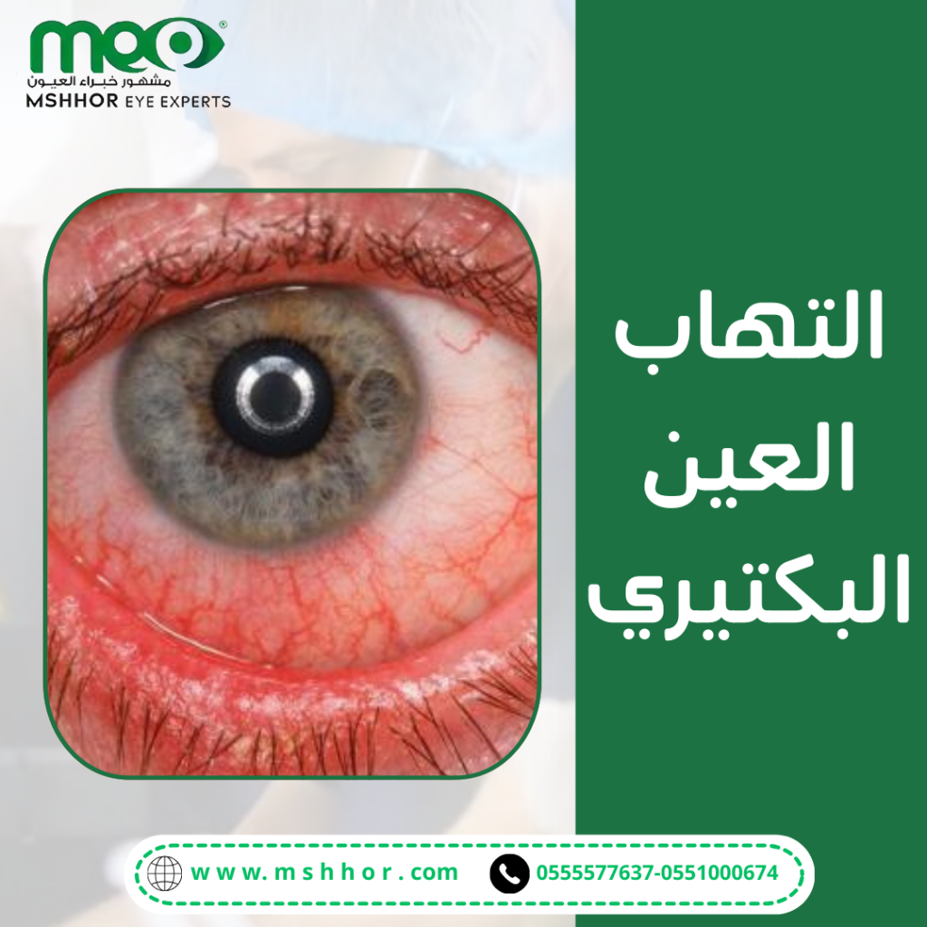 كيفية تشخيص التهاب العين البكتيري