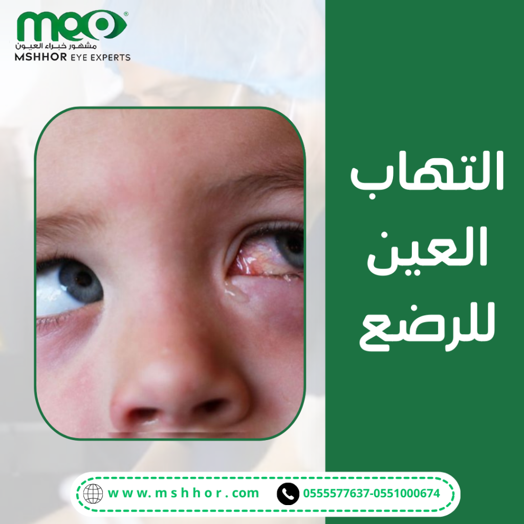 علاج التهاب العين للرضع