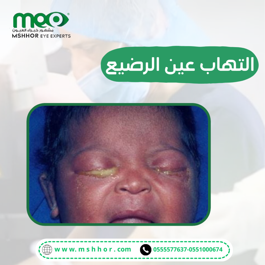 اسباب التهاب عين الرضيع