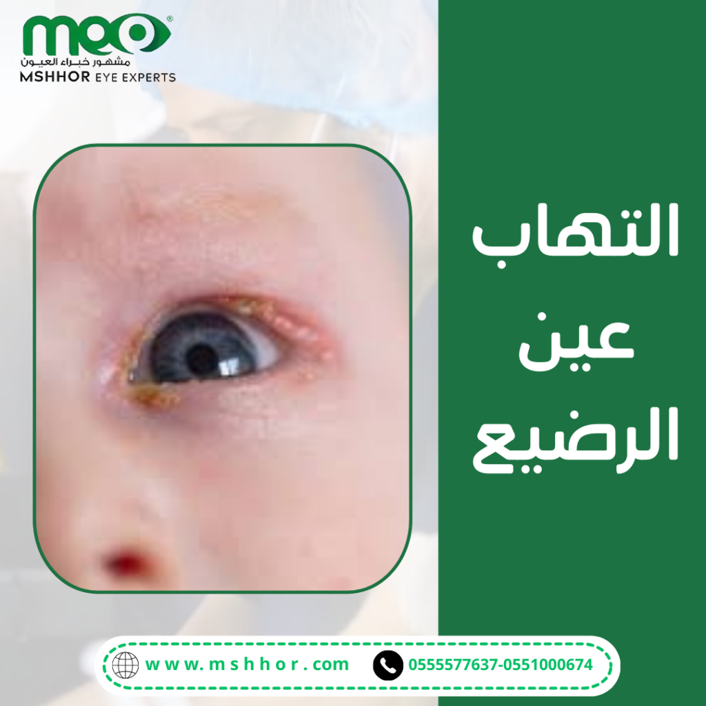طرق علاج التهاب عين الرضيع