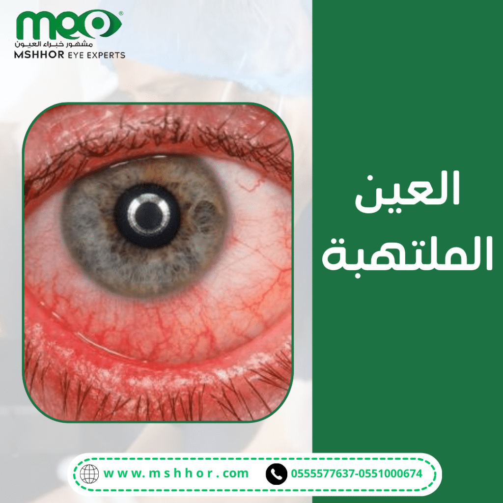 علاجات منزلية للتخفيف من أعراض العين الملتهبة
