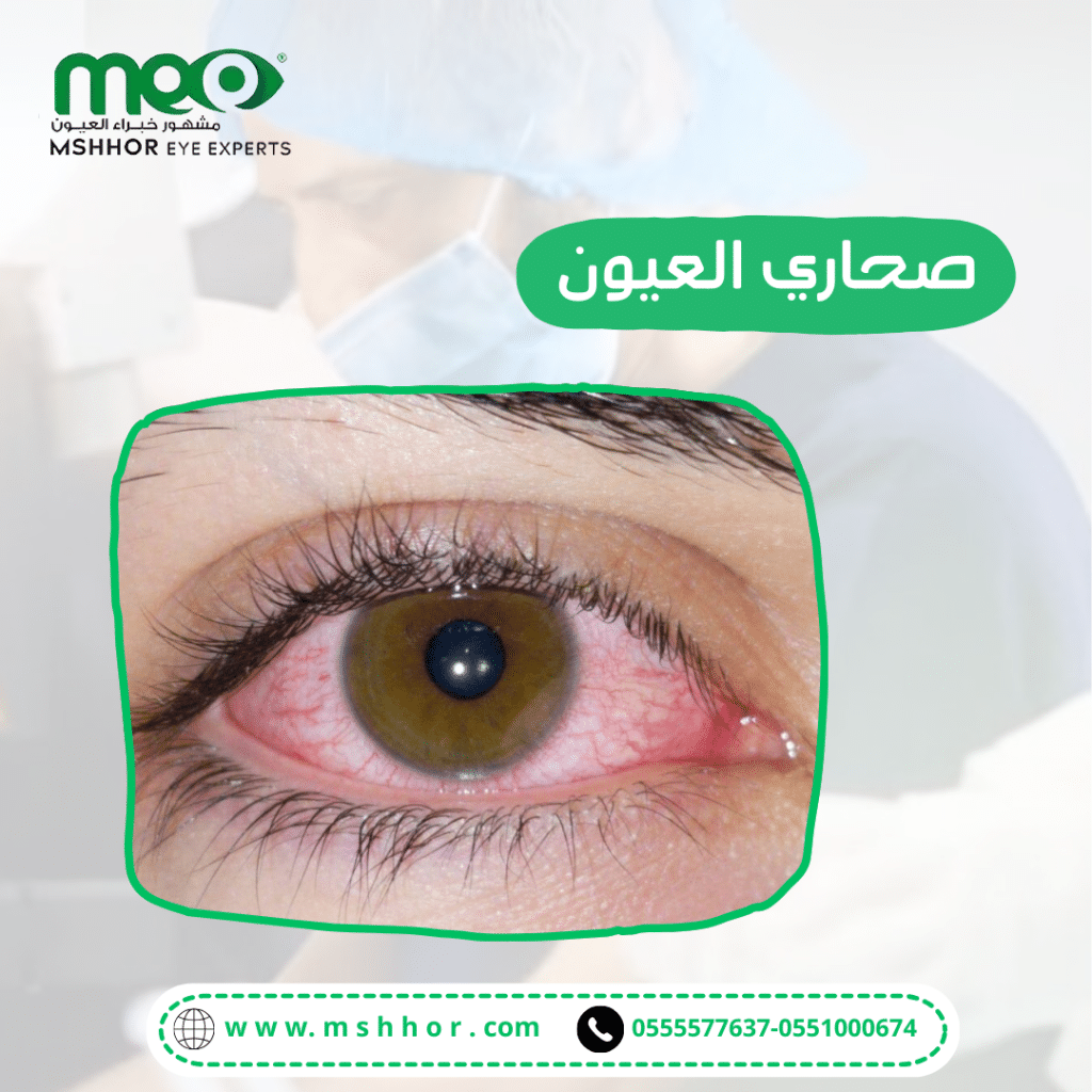 الأعراض الشائعة لصحاري العيون