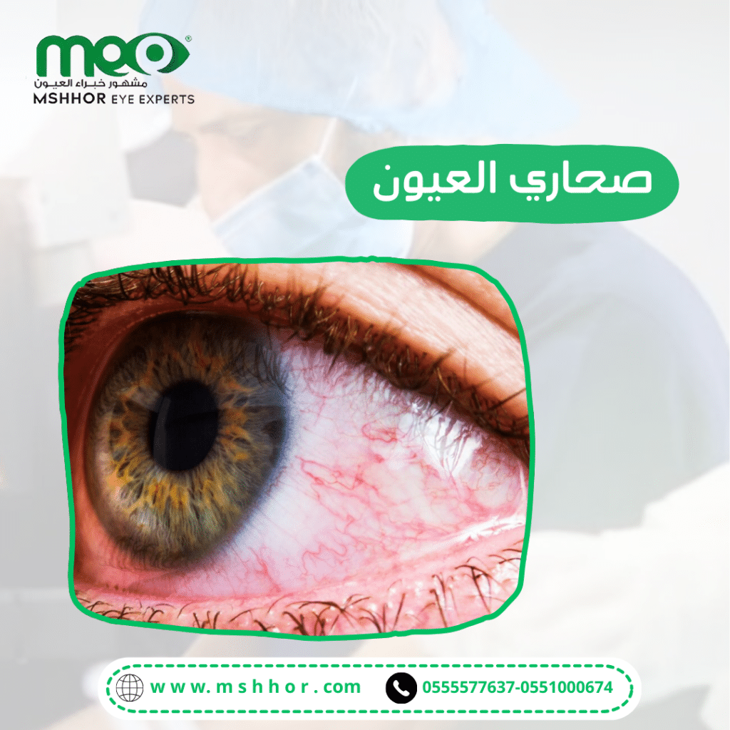 أنواع العلاجات الطبية المتاحة لصحاري العيون